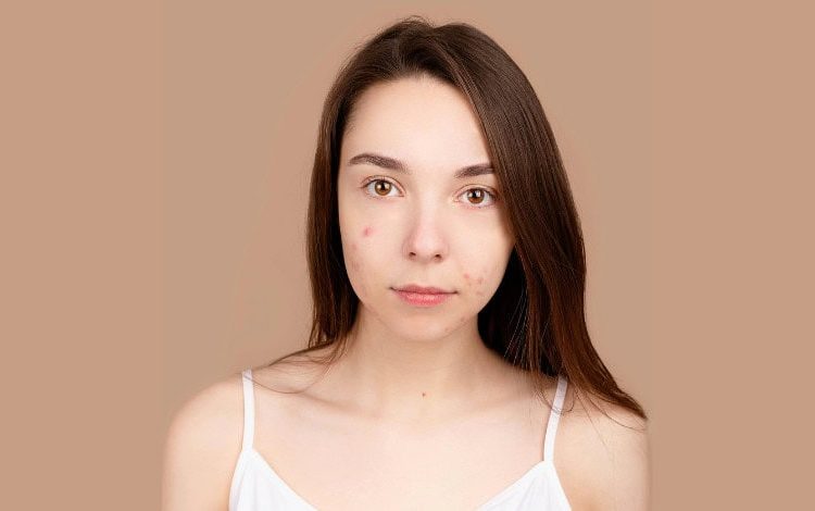 Endometrioza bljeskova? Ove namirnice bi mogle pogoršati stanje